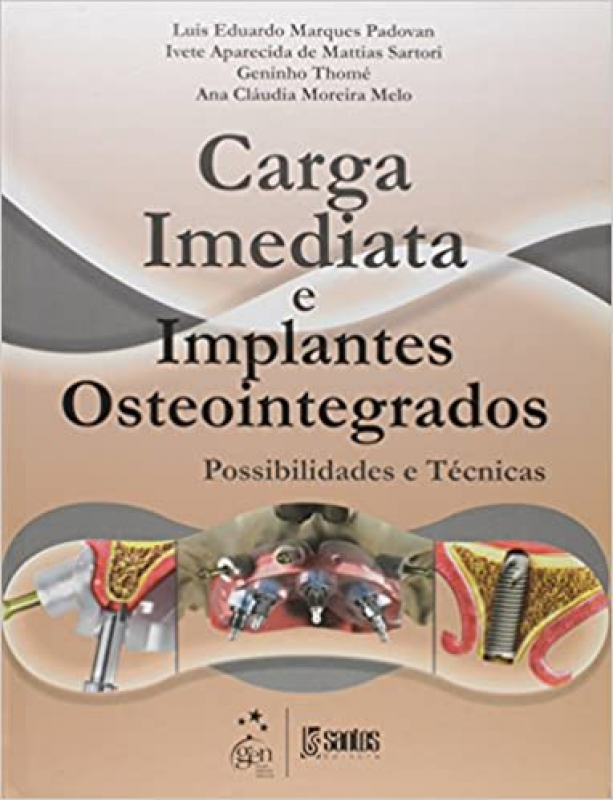 Carga Imediata e Implantes Osteointegrados - Possibilidades e Técnicas
